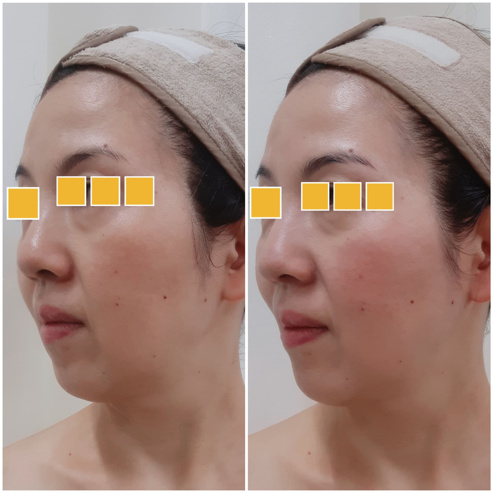 ※エステティックの施術（リセラフェイシャルプログラム）1回の結果です。