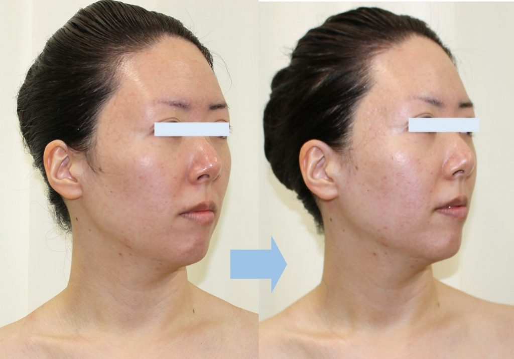 ※エステティックの施術（リセラフェイシャルプログラム1回の結果です。）