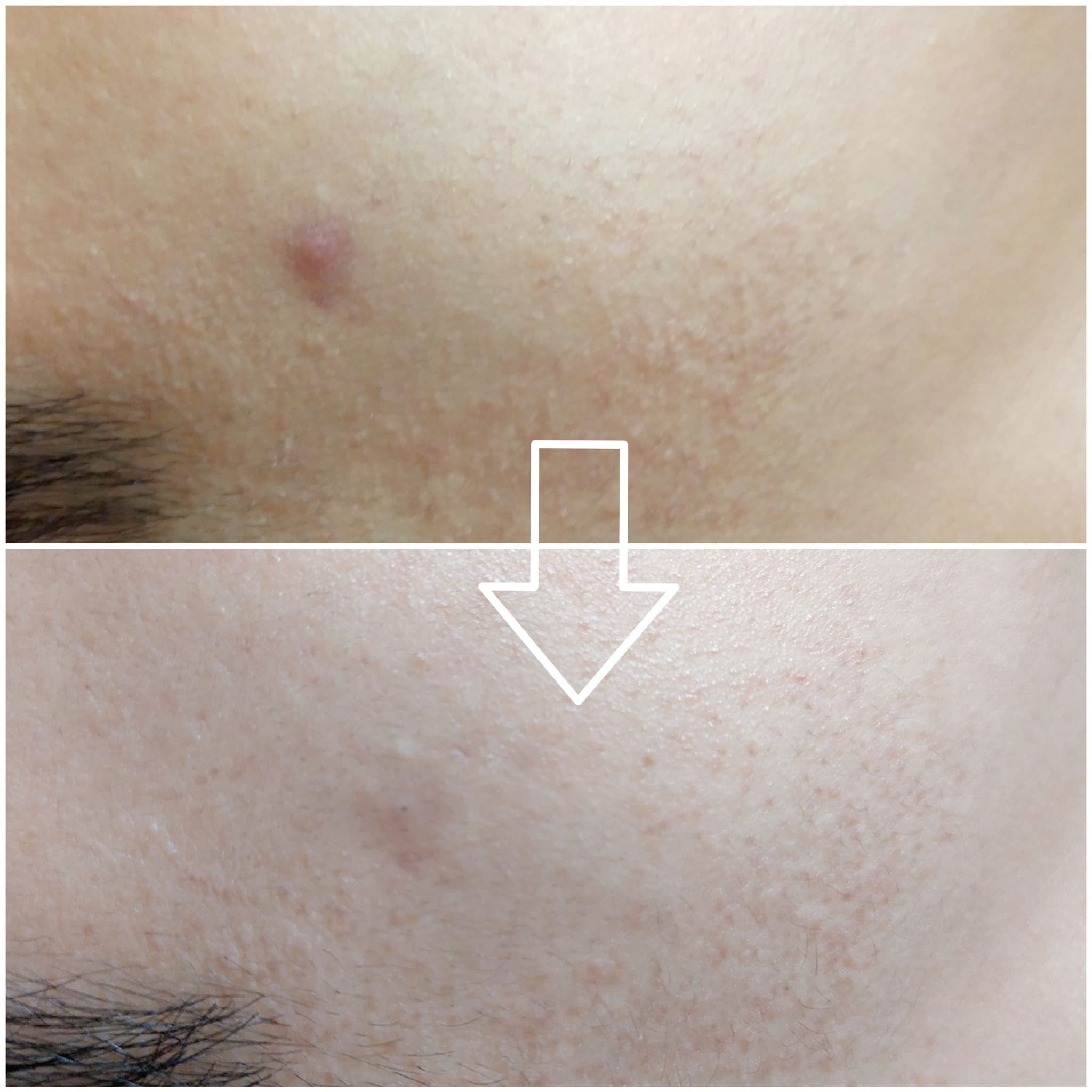 ※エステティックの施術（リセラフェイシャルプログラム）1回の結果です。<br />
※(下)施術後1週間