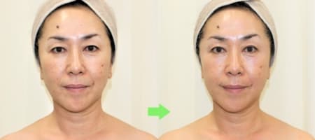 エステティックの施術（リセラフェイシャルプログラム）1回の結果です。