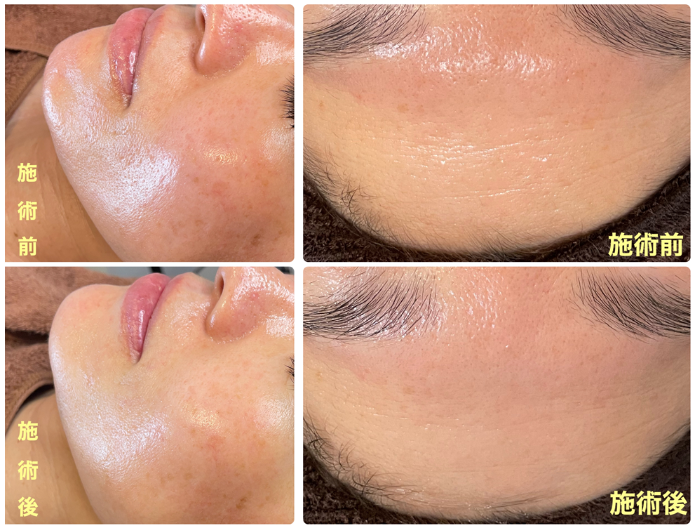 エステティックの施術（リセラフェイシャルプログラム）1回の結果です。
