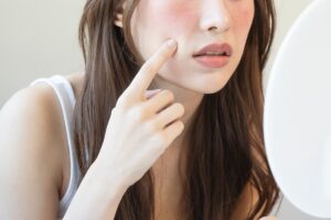 ニキビにパックはしない方がいい？エステのニキビケア事例もご紹介